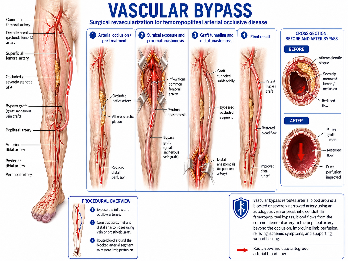 Vascular Bypass Surgery