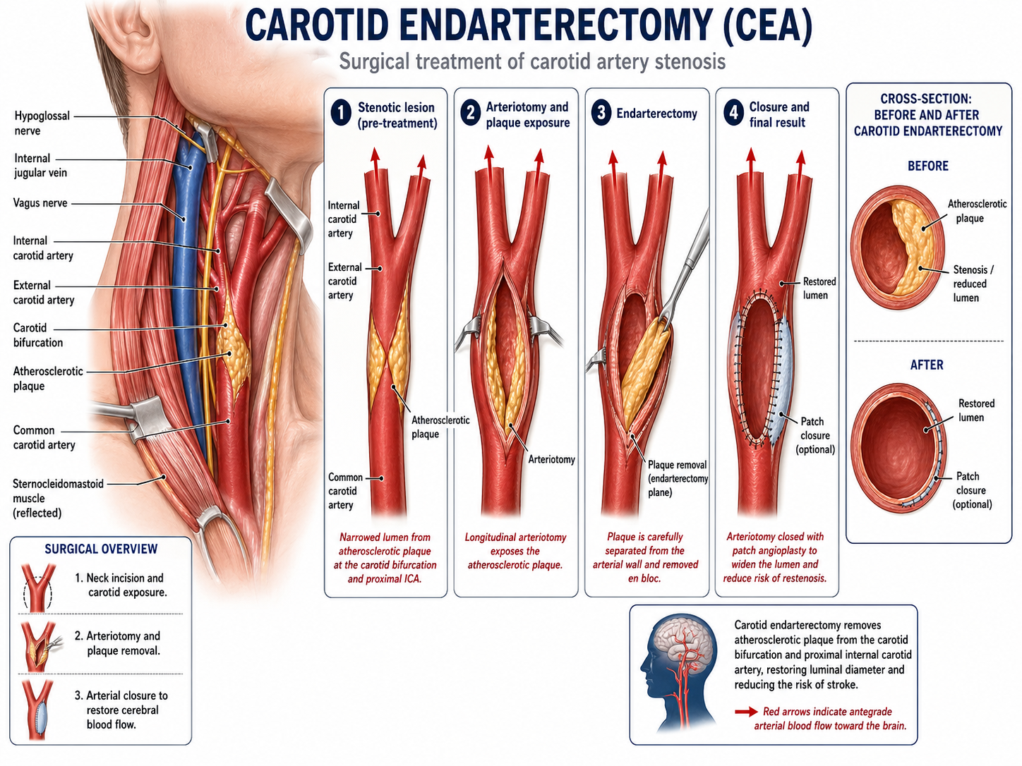 Carotid Endarterectomy
