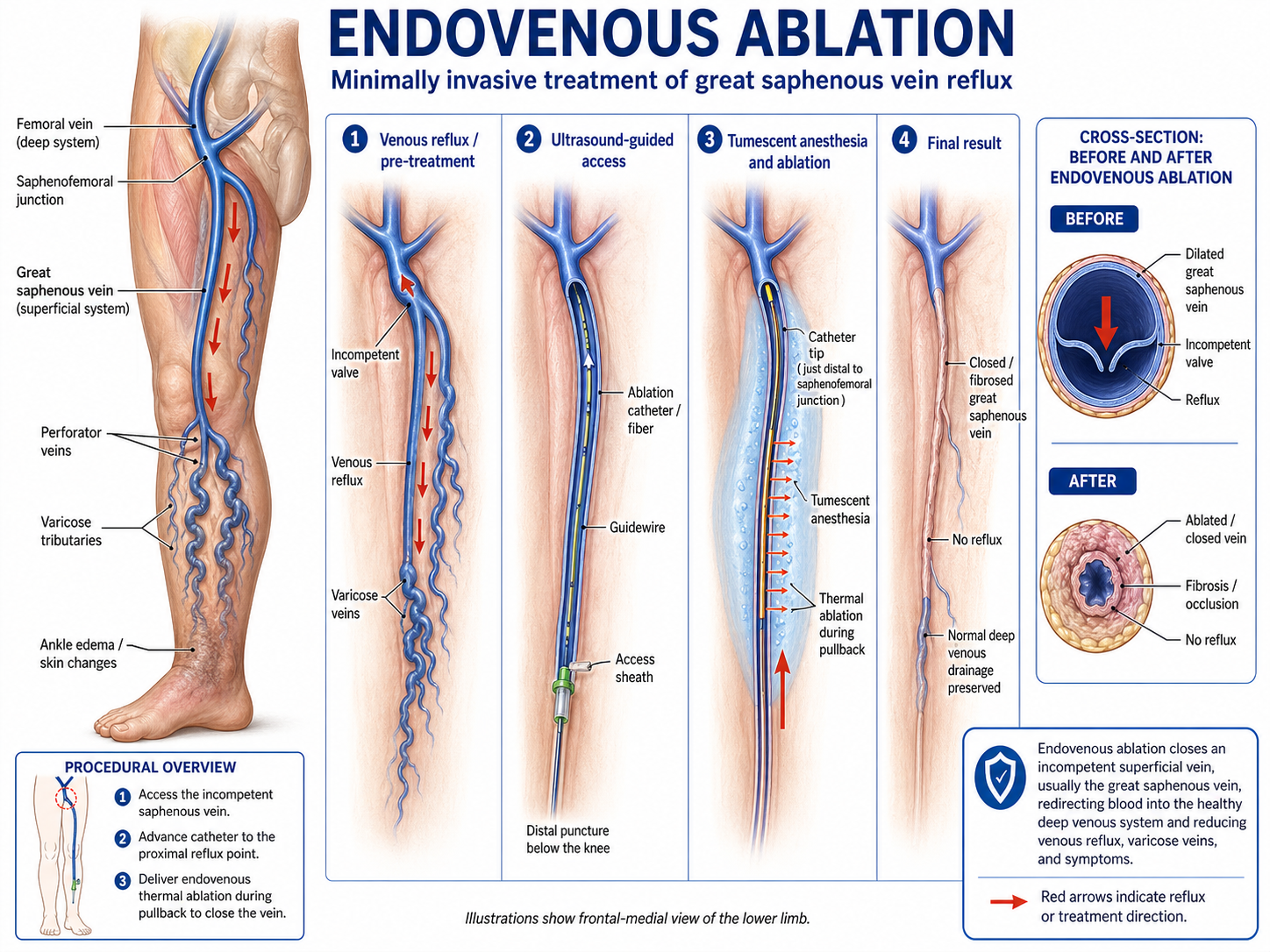 Endovenous Ablation